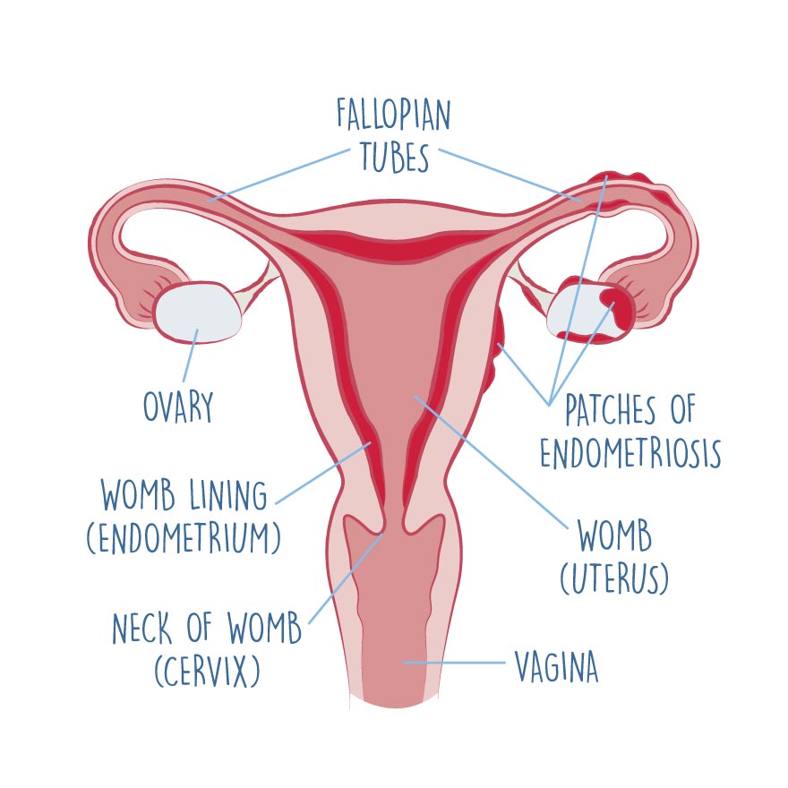 biology-of-endometriosis